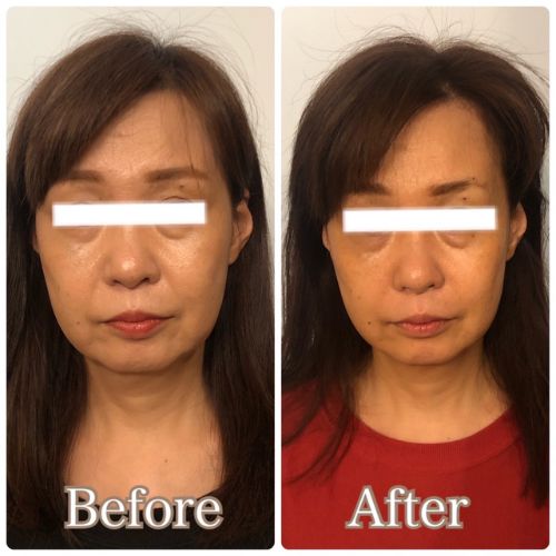 before&After