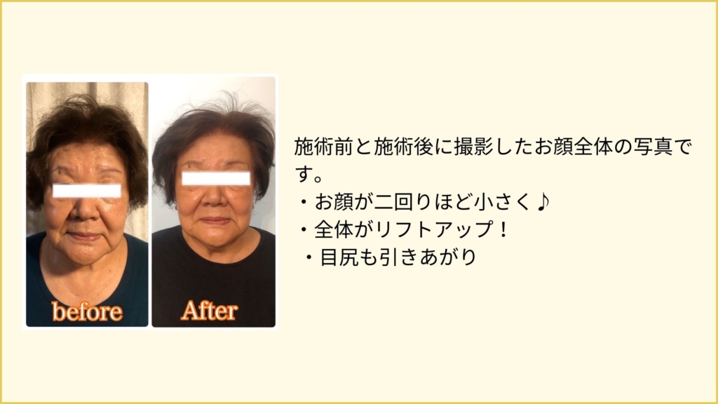 before after 4